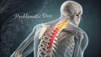 허리 디스크 관련 영어 표현: 'Herniated Disc'와 'Slipped Disc' 영어 단어 및 척추 그림 썸네일